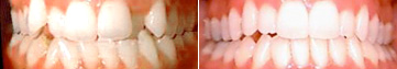 invisalign-before-after-nj-1