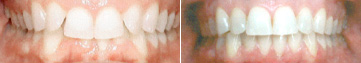 invisalign-before-after-nj-4