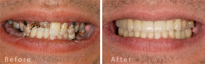 full-mouth-reconstruction-nj-patient-2.jpg