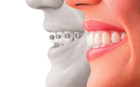 Invisalign: Why NJ Patients Should Try It