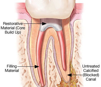 How to Tell If You Need a Root Canal